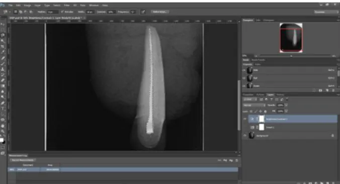 Figure  2.  The  use  of  Adobe  Photoshop  CC  2017 ®  software  and  magnetic  lasso  tool  to  measure  the  total  filling material area inside the root canal 