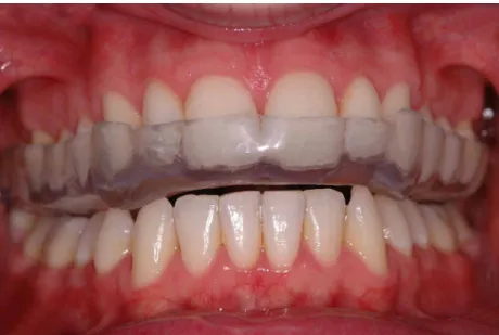 Figura 5 : Exemplo de placa oclusal em boca 