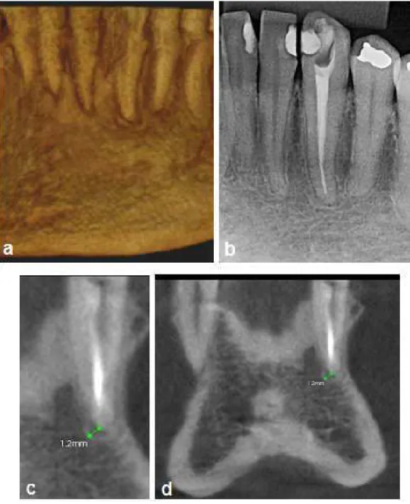 Figura 6. Caso clínico com acompanhamento de 2 anos. Reconstrução  em  3D  (a);  Radiografia  periapical  (b);  Índice  de  pontuação  periapical  CBCTPAI  -  2  em  corte  coronal  do  elemento  dental  33,  apresentando  diâmetro da área hipodensa periap