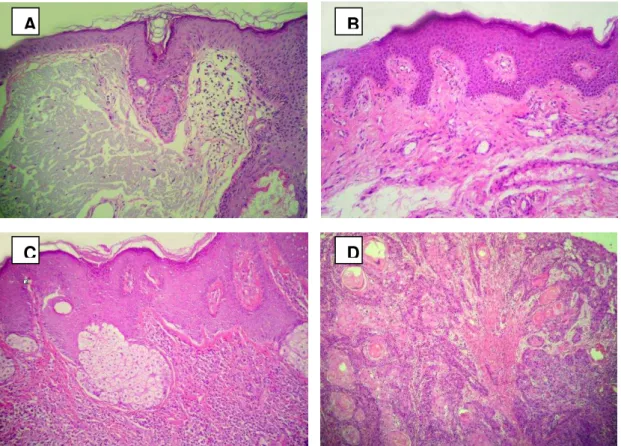Figure  1: Lesions  of  actinic  cheilitis.  A  Presence  of  solar  elastosis  in  injury  AC  with  moderate  dysplasia