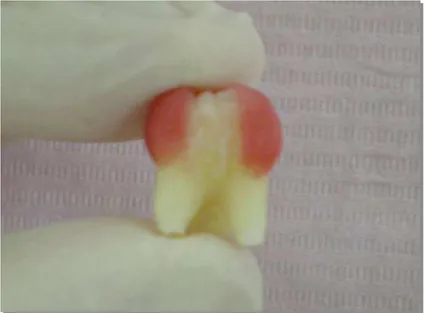 Figura 1 – Dente com as duas áreas controle isoladas e a área central exposta para posterior  aplicação do agente microabrasivo