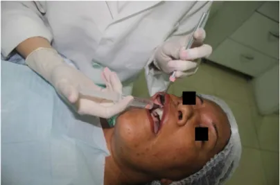 Figura 7: Aplicação anestésica intra oral (rede privada). 