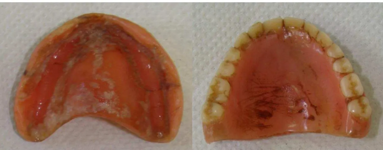 Figura 3 – Aspectos gerais das próteses dentárias: mais de 20 anos de uso, manchada, higiene  precária e biofilme visível