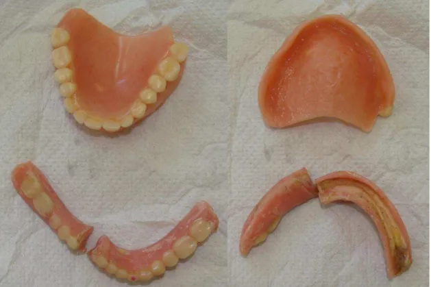 Figura 5 – Aspectos gerais das próteses dentárias: quebradas, com bordas cortantes e higiene  precária