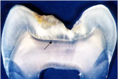 Figura 17 – Escore 2 – Cárie até o limite amelo-dentinário. 