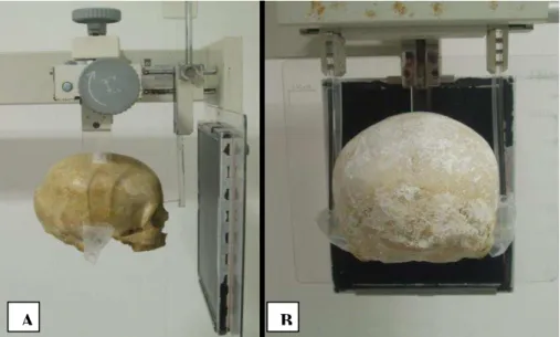 Figura 5  –  Posicionamento padrão do crânio para a técnica póstero-anterior de crânio, vista  lateral (A) e vista frontal (B)