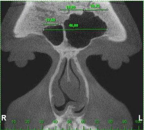 Figura 16 - Seio visualizado em secção coronal. Dados mensurados: distância entre o ponto  mais alto do seio direito e o limite máximo lateral direito; distância entre o ponto mais alto do  seio esquerdo e o limite máximo lateral esquerdo e a distância ent