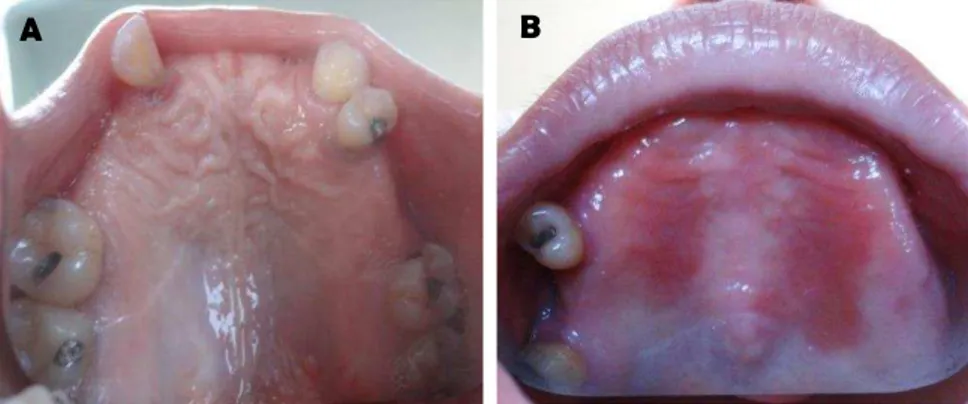 Figura 7: A) Paciente saudável, apresentando ausência de sinais  clínicos  da  estomatite  protética  (Inclusão  no  ensaio  clínico  Fase  I); B) Paciente portadora de estomatite protética tipo II (Exclusão  do ensaio clínico fase I)