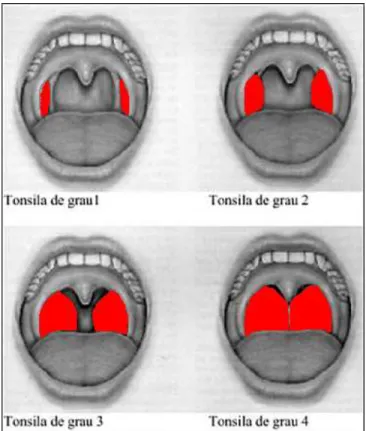 Figura 14: Esquema de hipertrofia de tonsilas palatinas proposto por L. Brodsky.  