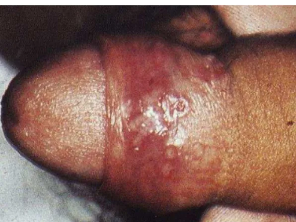 Figura 5 - Herpes genital 