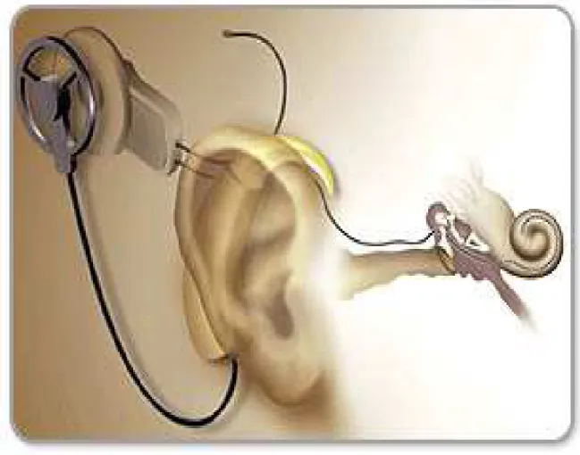Fig. 02. Ilustração do implante coclear dentro e fora da pele   Fonte: WWW.implantecoclear.com.br Acesso em 23.10.2010