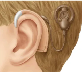 Fig. 03. Ilustração do implante coclear. 