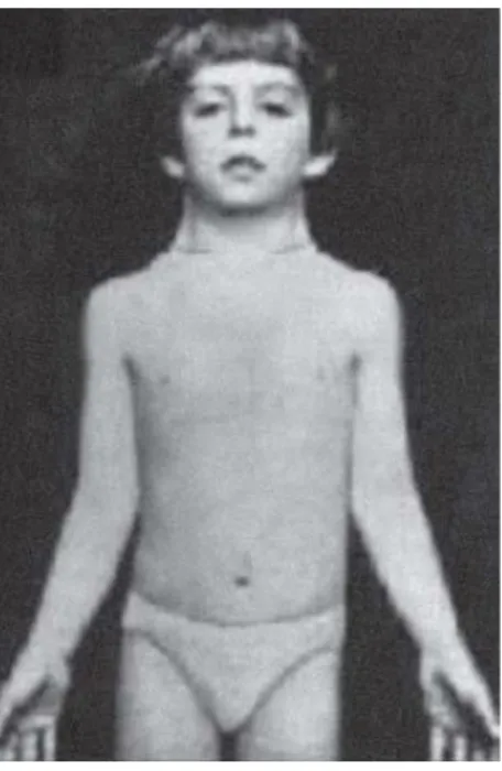 Figura 1.4 - Criança com características fenotípicas da síndrome de Turner, notando-se sobretudo o  cubitus valgus e o pescoço alado (Jung, Cardoso, Villar, &amp; Jr., 2009) 