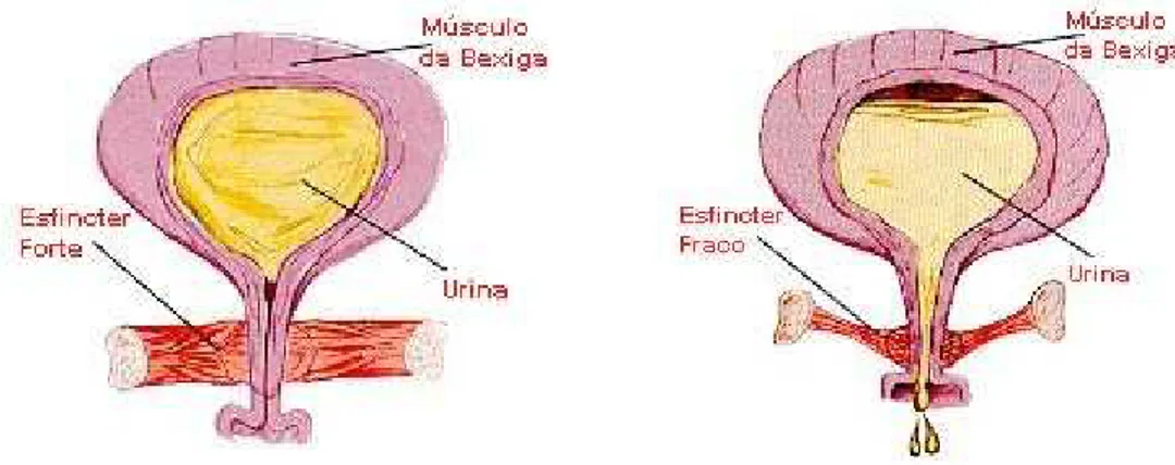 Figura I – Comparação entre o músculo esfíncteriano forte e o fraco  (Stein, 1995:153/154) 