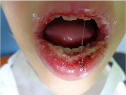 Figura 1 - Aspecto clínico de lesões de mucosite em lábio causada por quimioterapia 