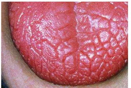 Figura 2 - Aspecto clínico da língua em paciente com xerostomia 
