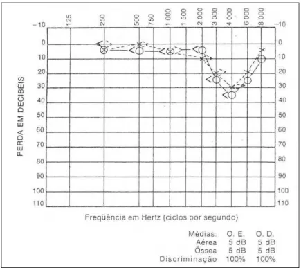 Gráfico 2 – Grau 2:Perda auditiva ultrapassa 30 dB na frequência  de 4000 Hz e já atinge as frequências vizinhas 