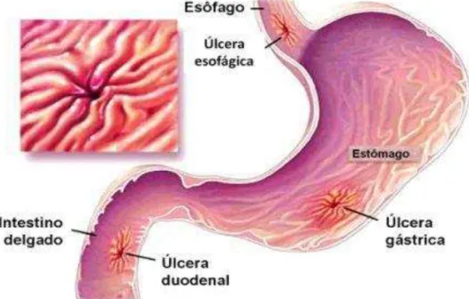 Figura 4. Úlcera péptica (adaptado de JAIN et al.,  2007) 