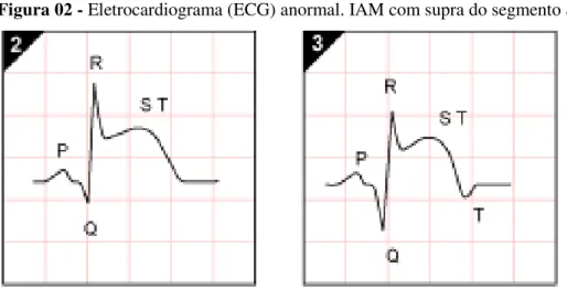 Figura 02 - Eletrocardiograma (ECG) anormal. IAM com supra do segmento ST 