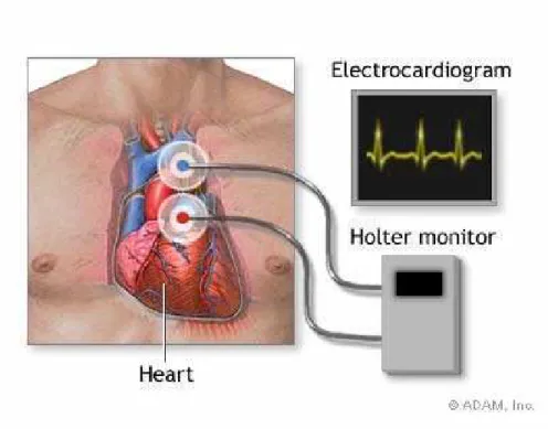 Figura 3.5. Atuação de um monitor holter 