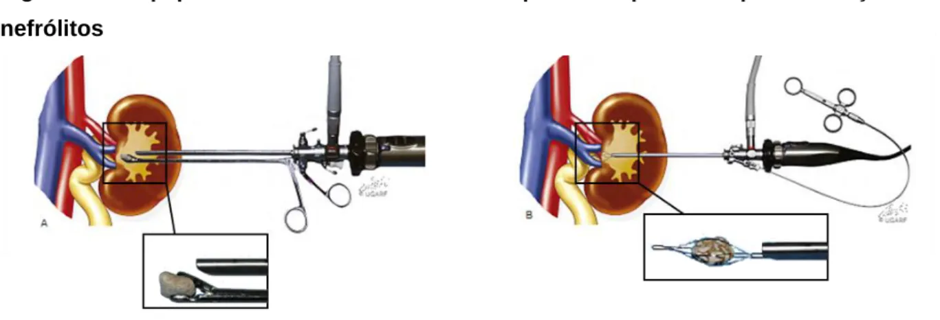 Figura  8  -  Equipamento  utilizado  na  nefroscopia  intraoperatória  para  remoção  de  nefrólitos 
