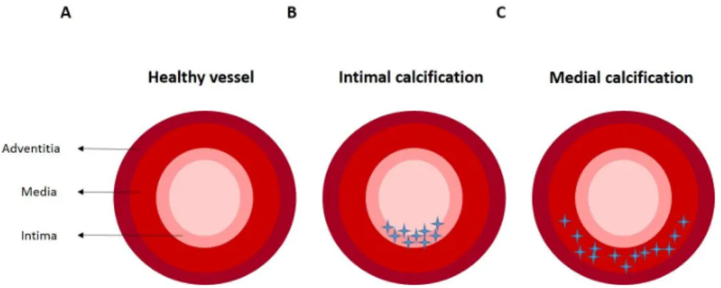 Figure 1.6 - Different types of vascular calcification in the arterial vessel wall. A) Healthy vessel in the  absence  of  calcification