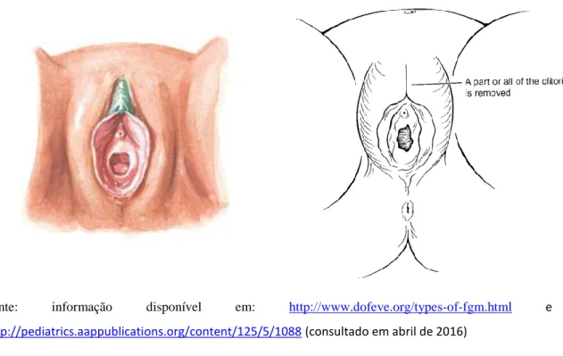 Fig. 3 e 4 – Clitoridectomia Ib: antes e depois 