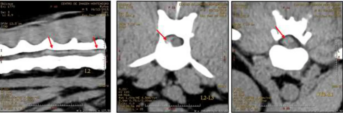 Figura 40:  Hérnia discal  Hansen tipo I em L2-L3 associado a hematoma com extensão até  T13-L1 (imagens cedidas pelo Centro de Imagem Montenegro)