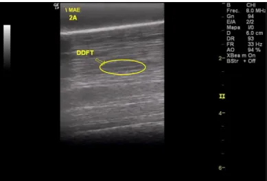 Figura  9:  Imagem  ecográfica  longitudinal  do  TFDP  na  zona  2A  –  1º  controlo  realizado  7  dias  após aplicação da terapia