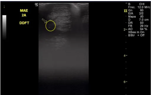 Figura  4:  Imagem  ecográfica  transversal  da  lesão  do  TFDP  do  MAE  na  zona  2A,  realizada  na  consulta de diagnóstico