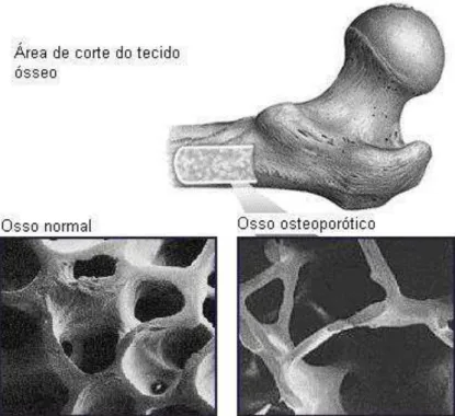 Figura  1:  Microradiografias  do  osso  trabecular  normal  e  osteoporótico  (adaptado  de  EDDY et al., 1998)