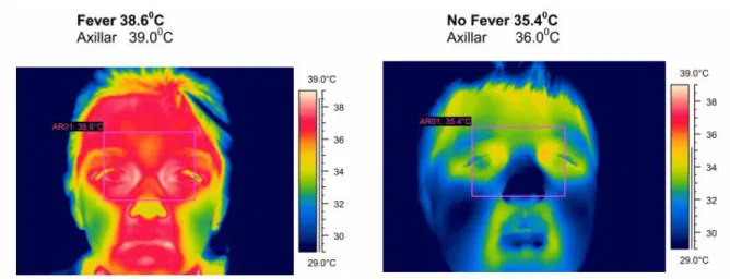 Figure 1 – Fever screening thermography