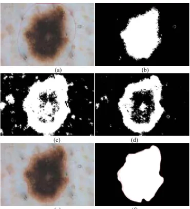 Fig. 3. An illustration of the proposed approach with the image in Fig. 1a: (a)  the initial curve (red contour); (b) the binary image generated with (18),  which is obtained by applying the Otsu’s method; (c) the binary image  generated with (28) based on