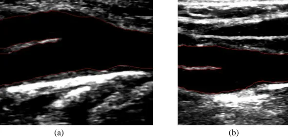 Figure  5:  Geometric  model  level  set  using  the  Chan-Vese  energy  minimization:  (a)  Identification  of  the  bifurcation boundaries of the carotid artery; (b) Identification of the lumen boundaries of the carotid artery