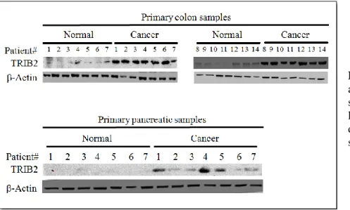 Figure  4.9.1:    Immunoblots  for  TRIB2  and  actin  in  our  primary  ex  vivo  clinical  samples