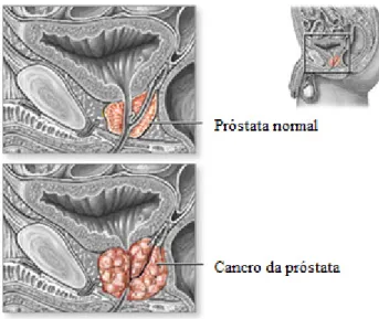 Figura 9 - Anatomia da próstata (adaptada de Zieve, 2013). 