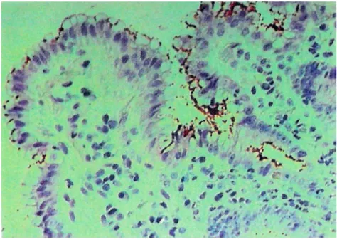 Figura 11 – Corte histológico de biopsia gástrica corado por hematoxilina/eosina, sendo  visíveis células de H