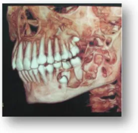 Figura  3  -Tomografia  computadorizada  em  3D,  mostrando  áreas  de  rarefação  óssea  (Flores et al., 2010) 