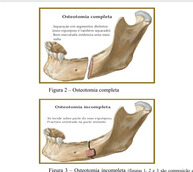 Figura 2 – Osteotomia completa