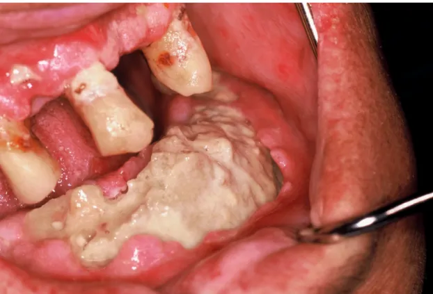 Figura 2. Osteonecrose da mandíbula de um paciente em terapia com ácido zoledrónico, para  o tratamento de doença óssea metastática com CaP