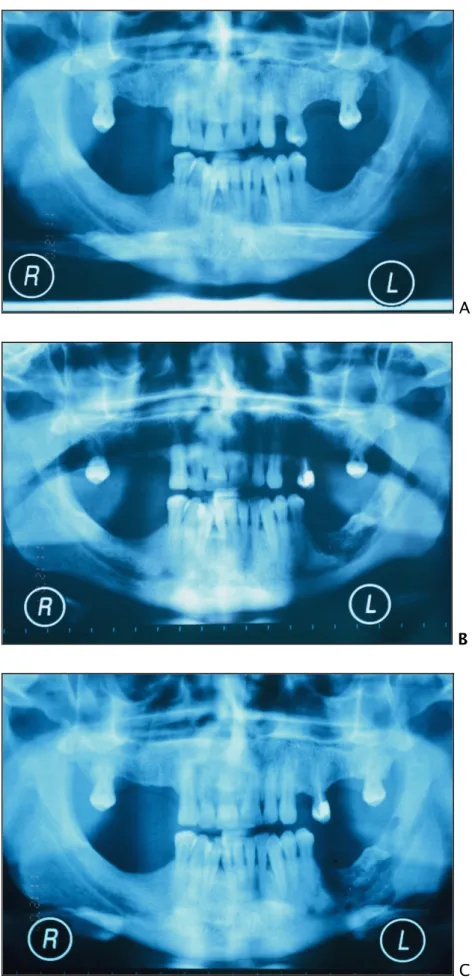 Figura 3. Evolução de uma ONB após uma cirurgia de extração dentária num paciente em  terapêutica com BF iv