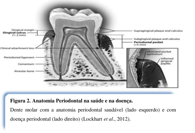 Figura 2. Anatomia Periodontal na saúde e na doença. 