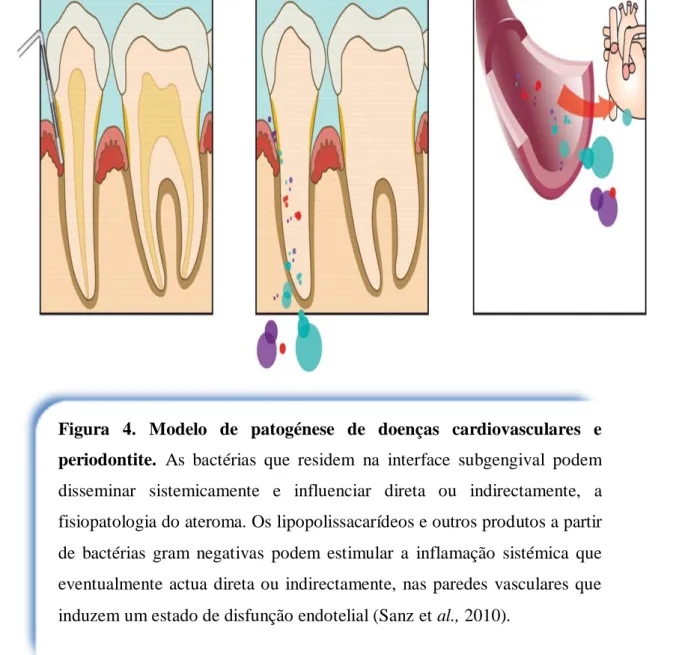 Figura  4.  Modelo  de  patogénese  de  doenças  cardiovasculares  e  periodontite.  As  bactérias  que  residem  na  interface  subgengival  podem  disseminar  sistemicamente  e  influenciar  direta  ou  indirectamente,  a  fisiopatologia do ateroma