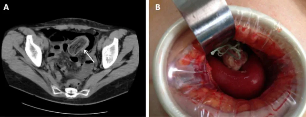 Figure 1 (A) CT scan demonstrating the tampon body in the abdominal cavity. (B) In situ tampon during minilaparotomy.