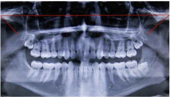 Figura 9  –  Traçados na ortopantomografia 