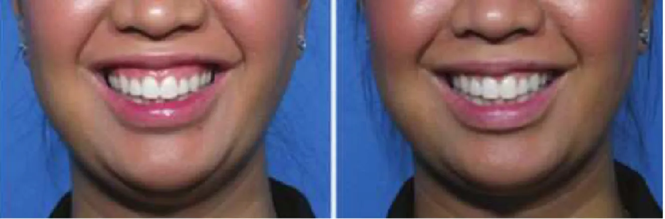 Figura 2 - O antes e depois do sorriso gengival aquando da utilização do botox. Adpatado e retirado de:  “Botox: 