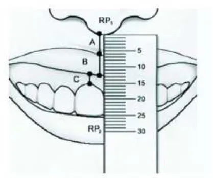 Figura 7 - Medição do sorriso gengival. Retirado e adaptado de: “Botulinum toxin tipe A in the treatment of the  excessive gingival display” (Polo, 2005) 