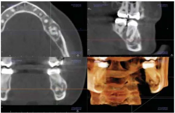 Figura 1- Imagens MPR, representando uma lesão apical associada ao dente 3.7. (adaptado de  Masri &amp; Driscoll, 2015) 