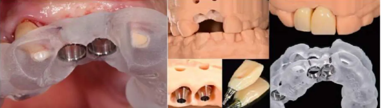Figura 8 - Imagens da guia cirúrgica em posição na cavidade oral, os respetivos modelos e a prótese  provisória (adaptado de Pascual &amp; Vaysse, 2015) 