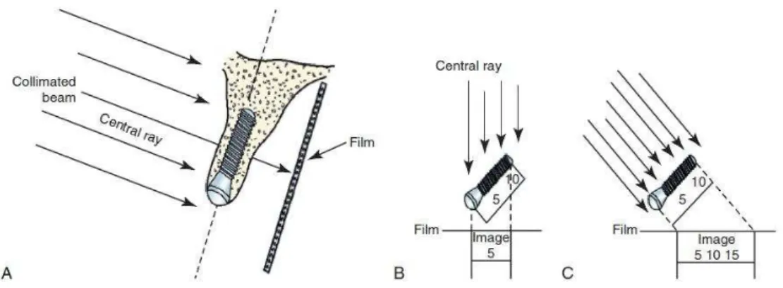 Figura 3 - Posicionamento da película. A - Posicionamento pela técnica do paralelismo; B - A fonte de  raios X encontra -se perpendicular à película mas não ao implante, resultando em encurtamento; C - A  fonte  de  raios  X  encontra -se  perpendicular  a